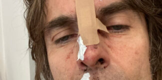 Liam Gallagher com o rosto machucado